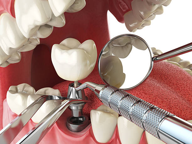 Best Emergency Wisdom Tooth Extraction in Holdrege, NE